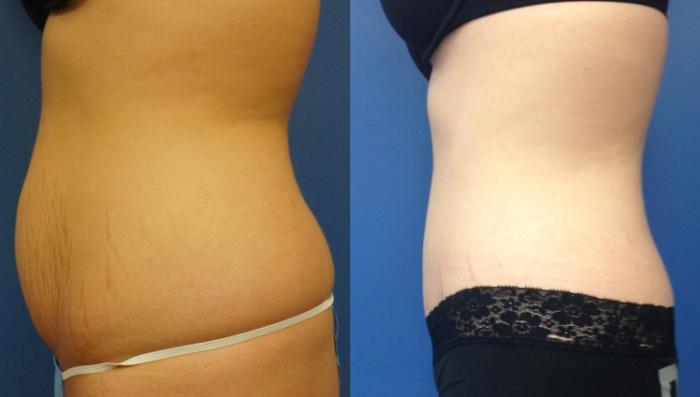 Before & After Tummy Tuck (Abdominoplasty) Case 5 View #3 View in Gilbert, AZ