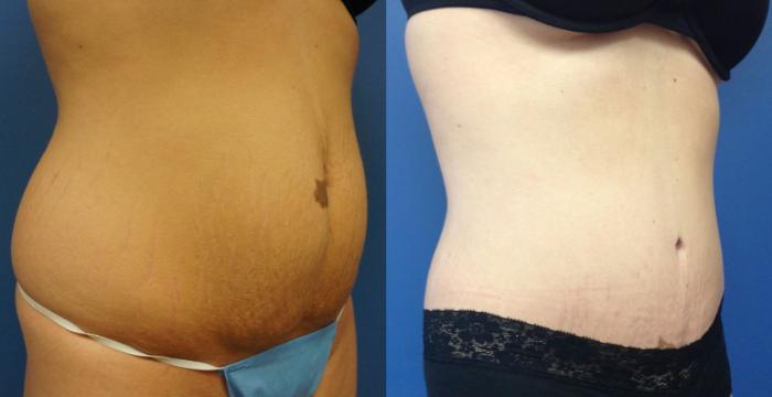 Before & After Tummy Tuck (Abdominoplasty) Case 5 View #4 View in Gilbert, AZ