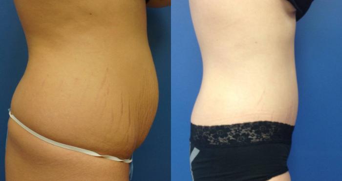 Before & After Tummy Tuck (Abdominoplasty) Case 5 View #5 View in Gilbert, AZ