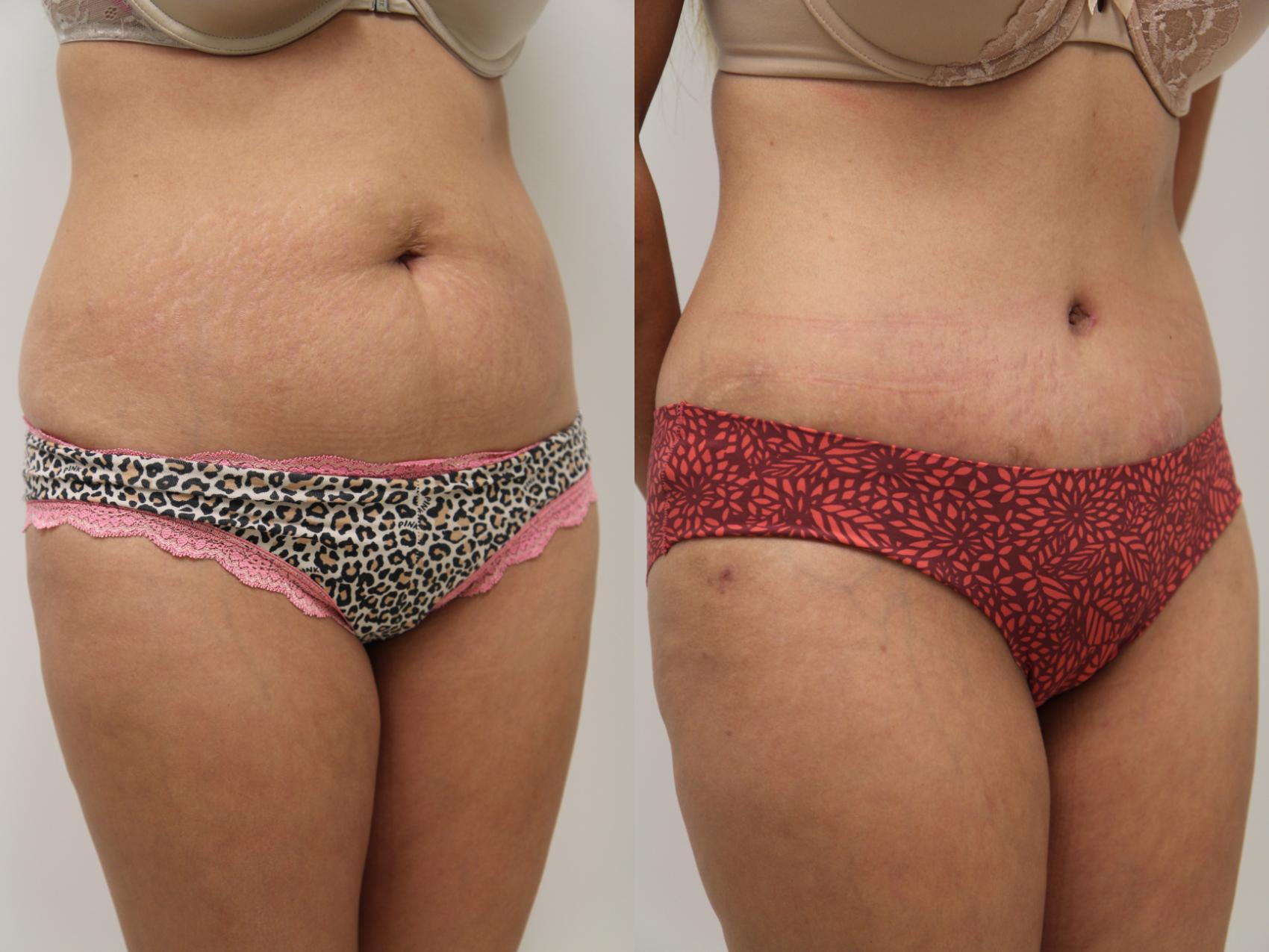 Tummy Tuck (Abdominoplasty) Before and After Pictures Case 66, Gilbert, AZ