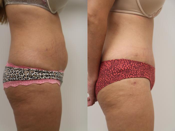 Before & After Tummy Tuck (Abdominoplasty) Case 66 View #3 View in Gilbert, AZ