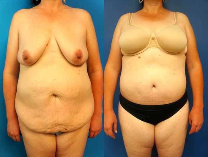 Before & After Tummy Tuck (Abdominoplasty) Case 7 View #2 View in Gilbert, AZ