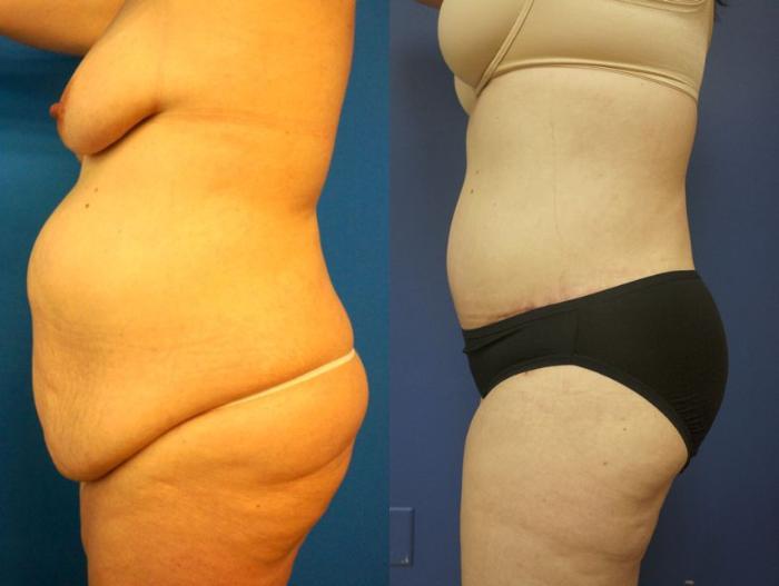 Before & After Tummy Tuck (Abdominoplasty) Case 7 View #3 View in Gilbert, AZ