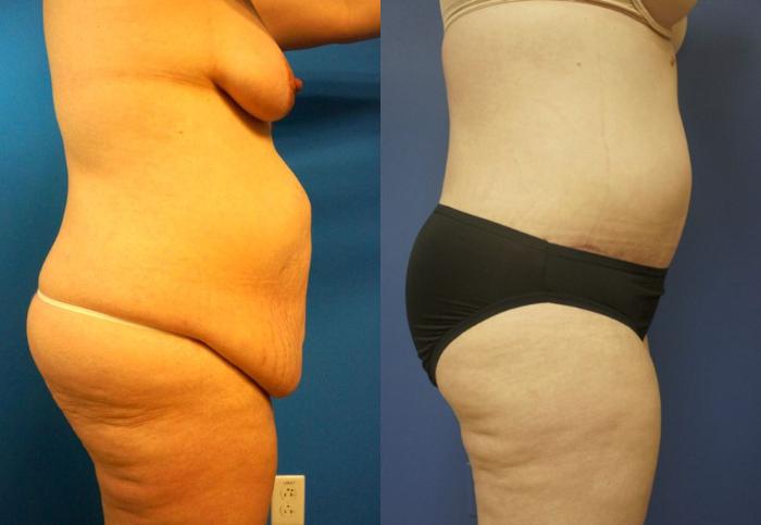 Before & After Tummy Tuck (Abdominoplasty) Case 7 View #4 View in Gilbert, AZ