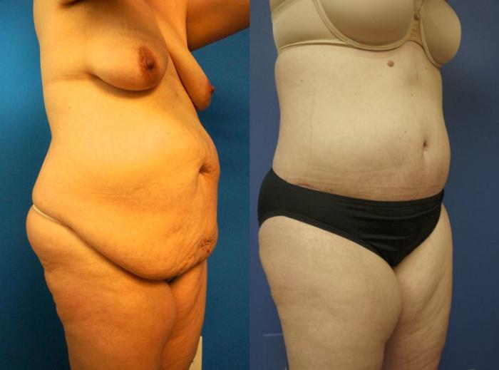 Before & After Tummy Tuck (Abdominoplasty) Case 7 View #5 View in Gilbert, AZ
