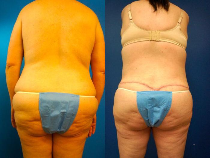 Before & After Tummy Tuck (Abdominoplasty) Case 7 View #6 View in Gilbert, AZ
