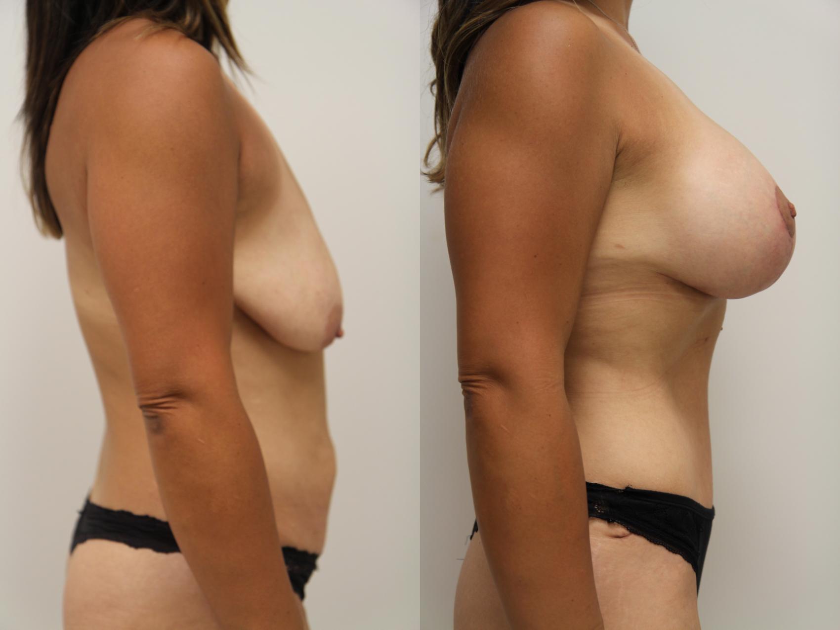 Before & After Tummy Tuck (Abdominoplasty) Case 70 View #3 View in Gilbert, AZ