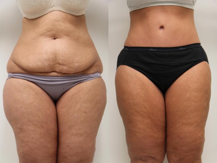 Before & After Tummy Tuck (Abdominoplasty) Case 71 View #1 View in Gilbert, AZ