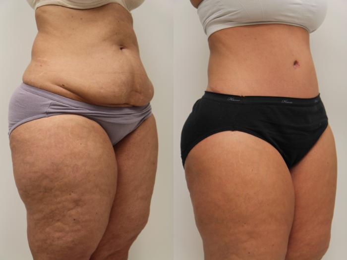 Before & After Tummy Tuck (Abdominoplasty) Case 71 View #2 View in Gilbert, AZ