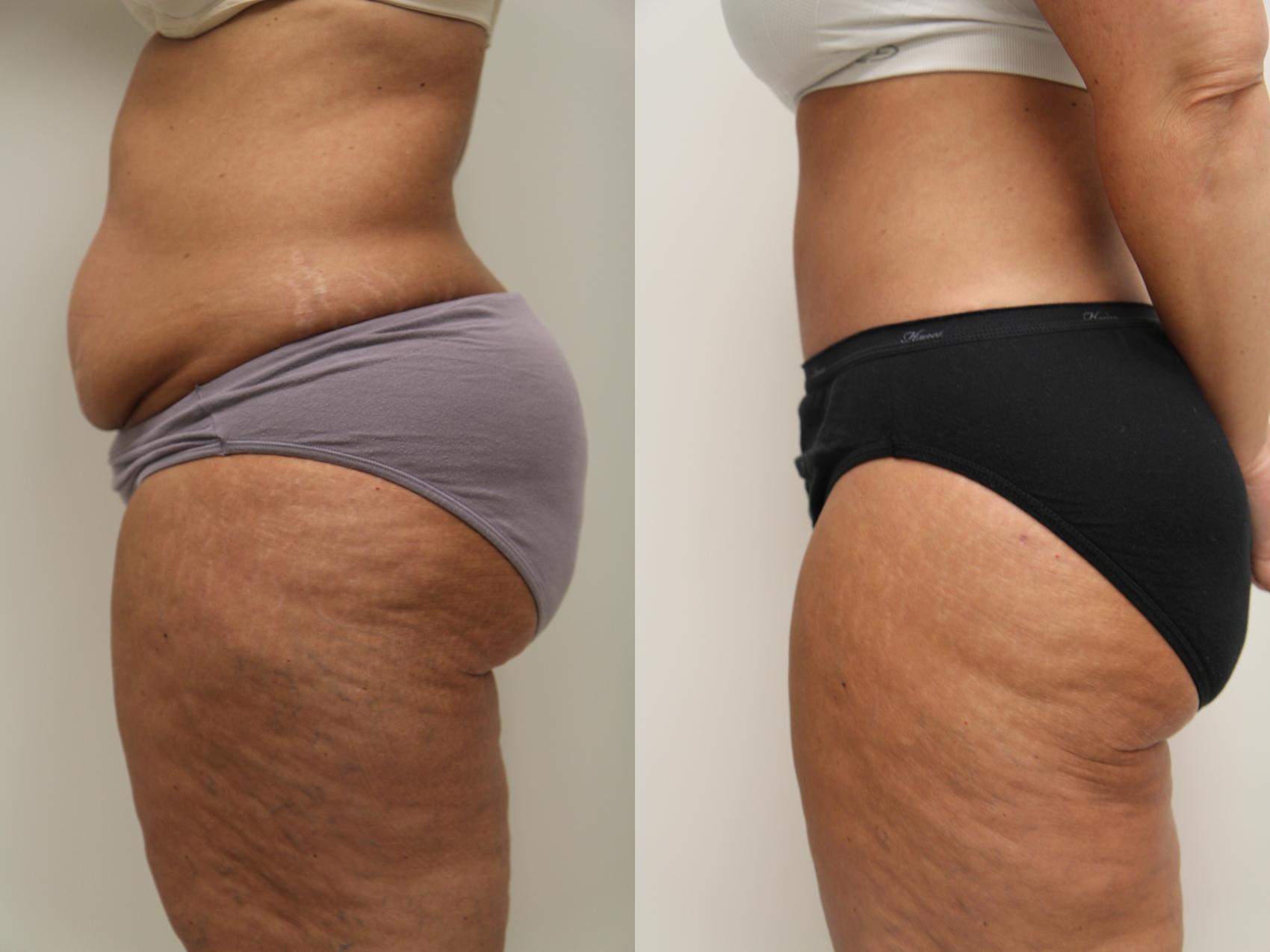 Before & After Abdominoplasty (Tummy Tuck) Case 71 View #3 View in Gilbert, AZ