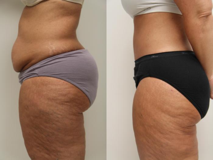 Before & After Tummy Tuck (Abdominoplasty) Case 71 View #3 View in Gilbert, AZ