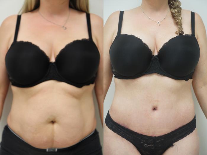 Before & After Tummy Tuck (Abdominoplasty) Case 83 View #1 View in Gilbert, AZ