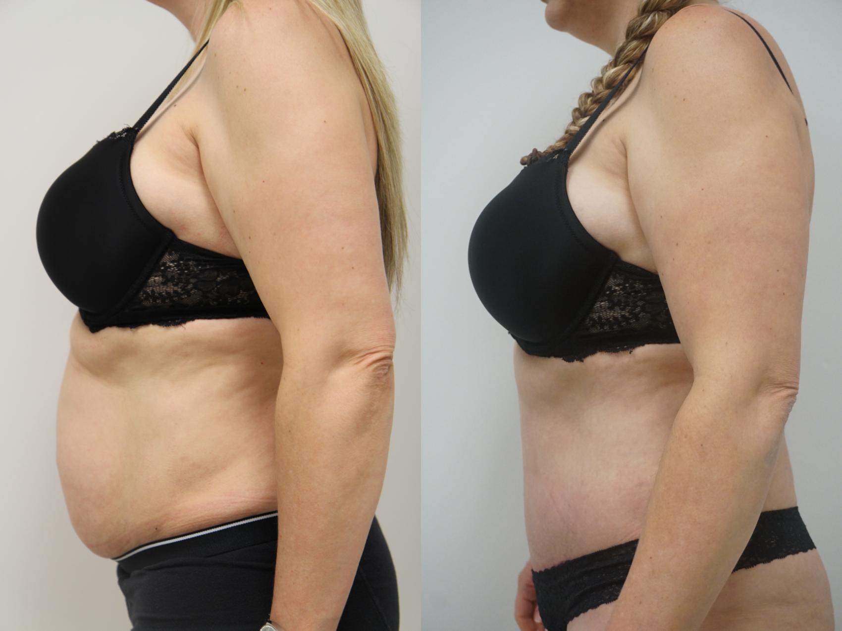 Before & After Tummy Tuck (Abdominoplasty) Case 83 View #2 View in Gilbert, AZ