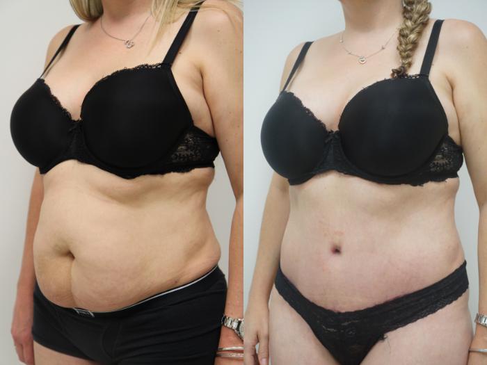 Before & After Tummy Tuck (Abdominoplasty) Case 83 View #3 View in Gilbert, AZ