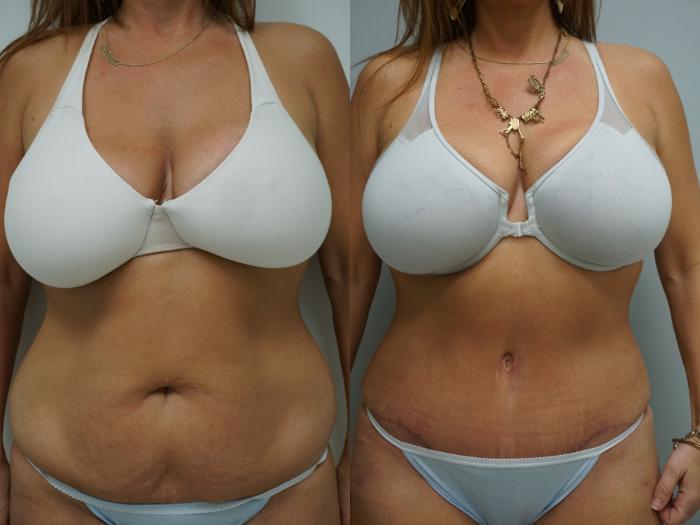 Before & After Tummy Tuck (Abdominoplasty) Case 93 View #1 View in Gilbert, AZ