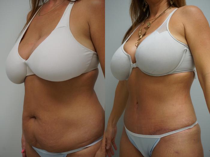 Before & After Tummy Tuck (Abdominoplasty) Case 93 View #2 View in Gilbert, AZ