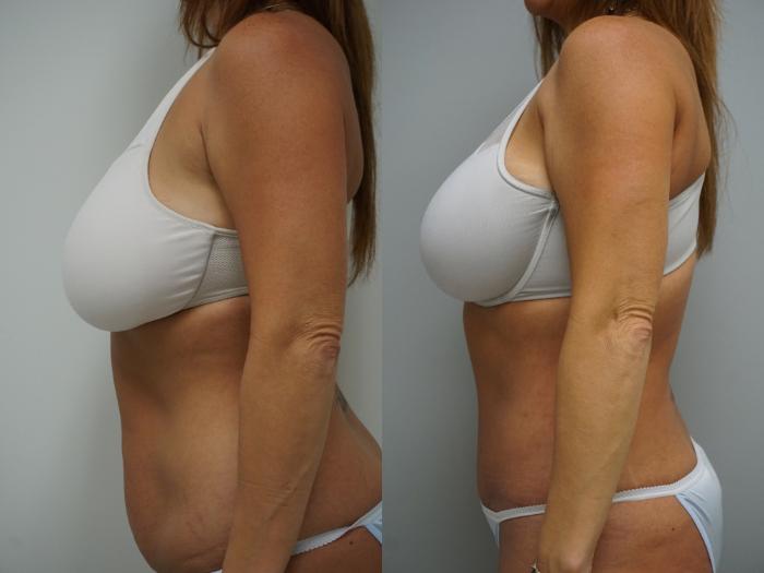 Before & After Tummy Tuck (Abdominoplasty) Case 93 View #3 View in Gilbert, AZ