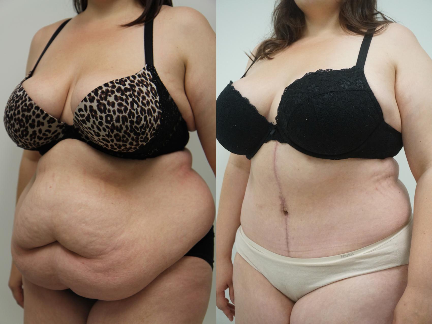 Tummy Tuck (Abdominoplasty) Before and After Pictures Case 97