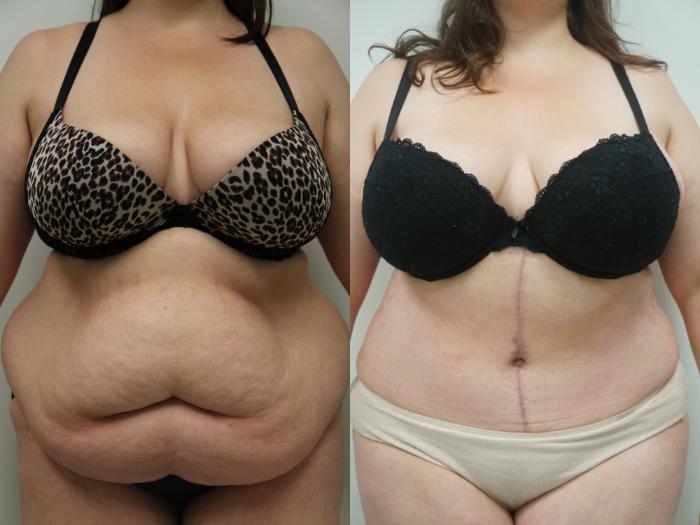 Before & After Tummy Tuck (Abdominoplasty) Case 97 View #2 View in Gilbert, AZ