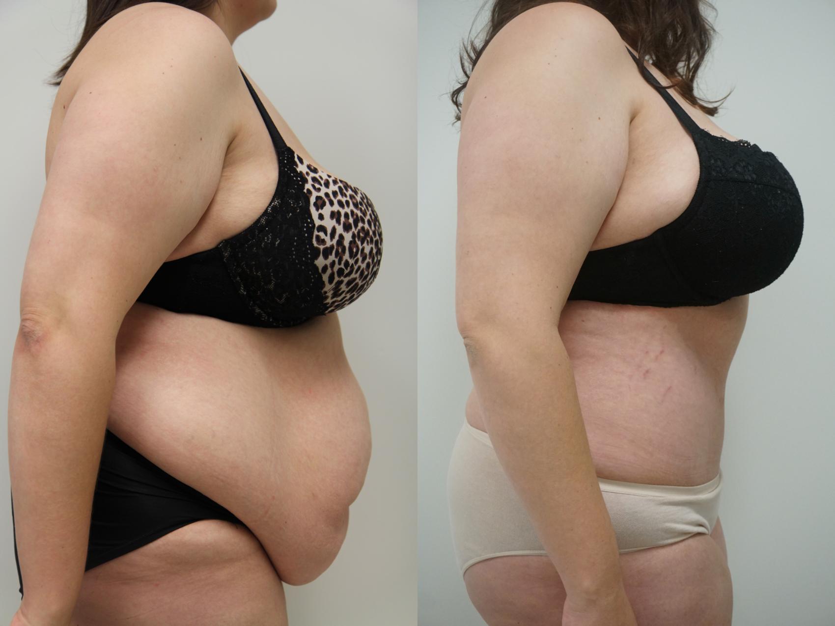 tummy tuck before and after