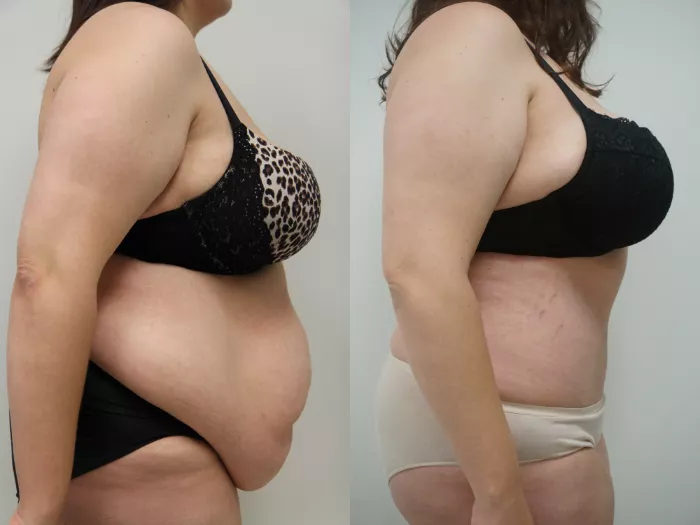 Plus Size Tummy Tuck Before and After